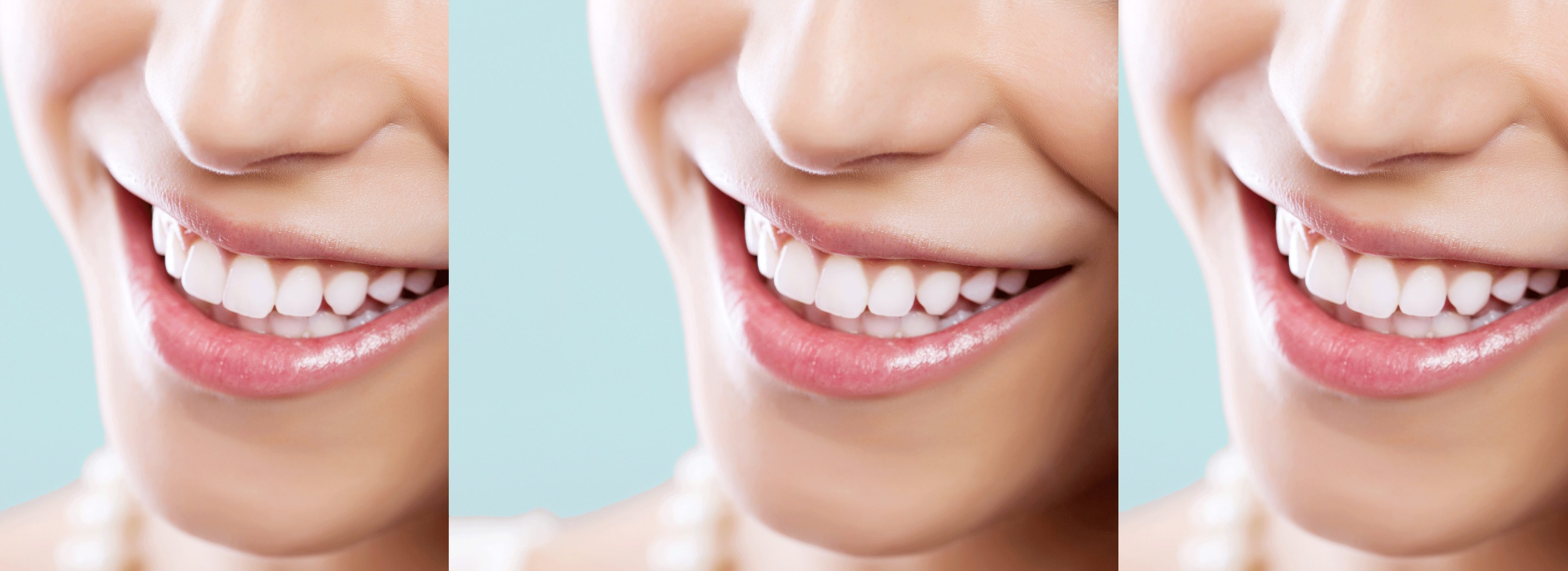 Stylsmile teeth whitener