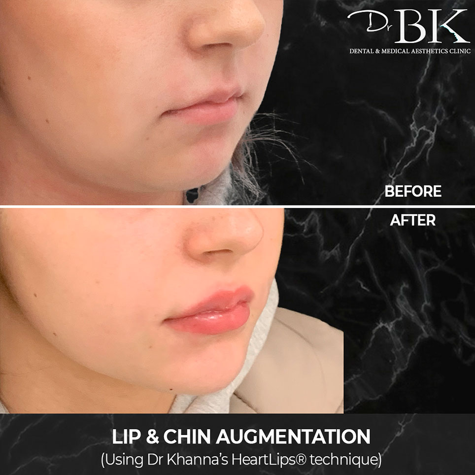 DrBK_AugmentationLips